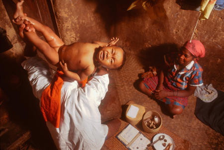 A Malagasy child is treated by a traditional healer for a condition called Taitaitra. Actually growth spasms, parents believe the crying is caused by evil spirits attaching themselves to infants.